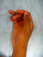 Flexor Tendon Injury Photo